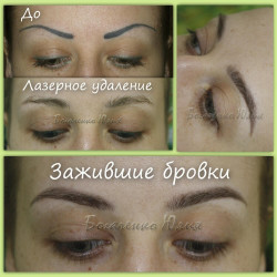 tattoo-laser-removal-before-after-3